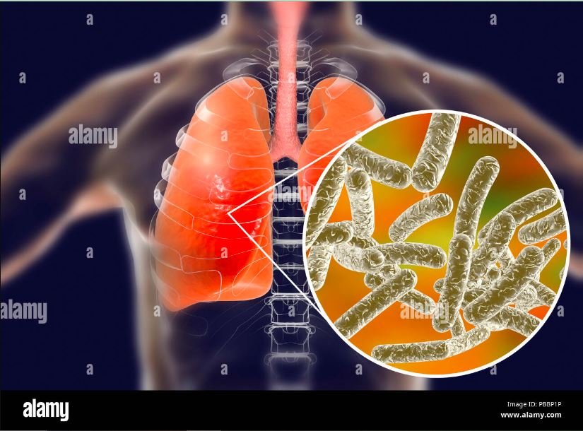 Lincoln, NH Legionnaires’ Disease: Causes, Symptoms, and Prevention